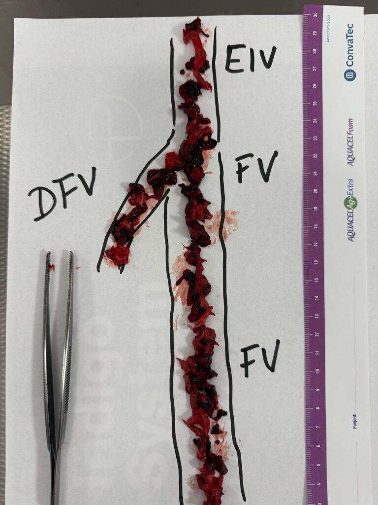 Zdjęcie przedstawia usuniętą skrzeplinę ułożoną zgodnie z anatomicznym przebiegiem żył biodrowo-udowych, którą usunięto za pomocą systemu Indigo Lightning Bolt 12.