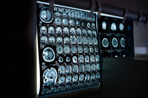 zdjęcie rezonansu głowy